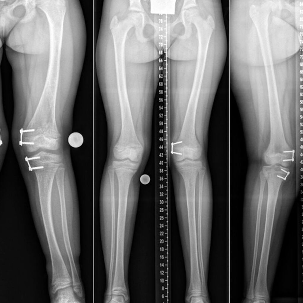 Hypophosphatämie und Deformität multidisziplinäres Management Orthopädie & Traumatologie